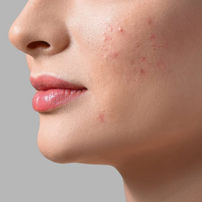 Acne Da Mulher Adulta Entenda O Que E Como Tratar