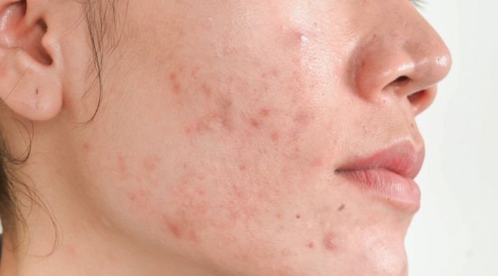 modelo com acne no rosto