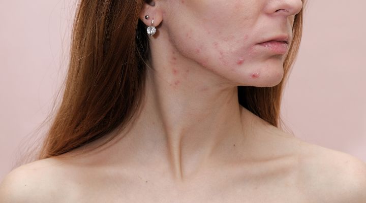 acne no rosto 