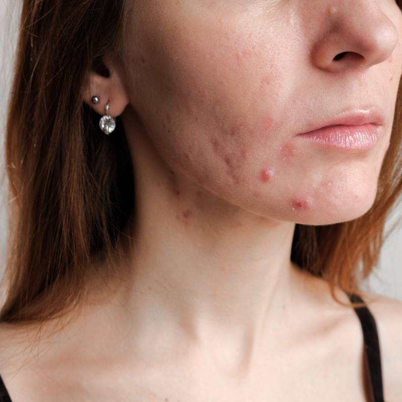 moça com as bochechas cheias de acnes