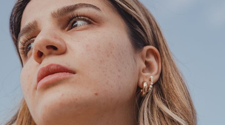 Foto do rosto de uma mulher com manchas de acne. 