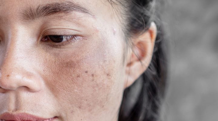 Foto do rosto de uma mulher que apresenta manchas de melasma na bochecha.