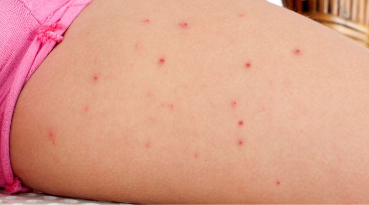 marcas avermelhadas de foliculite na pele