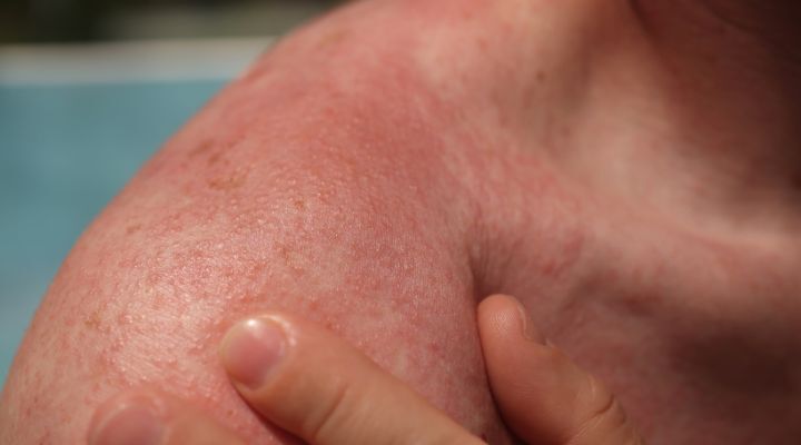 Pele com irritação e vermelhidão no ombro