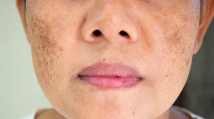 modelo com rosto cheio de mancha marrom da melasma