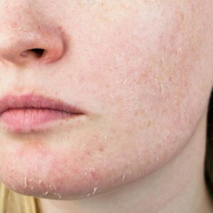 Rosto feminino descascando e avermelhado simbolizando a pele seca