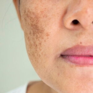 modelo com mancha de melasma