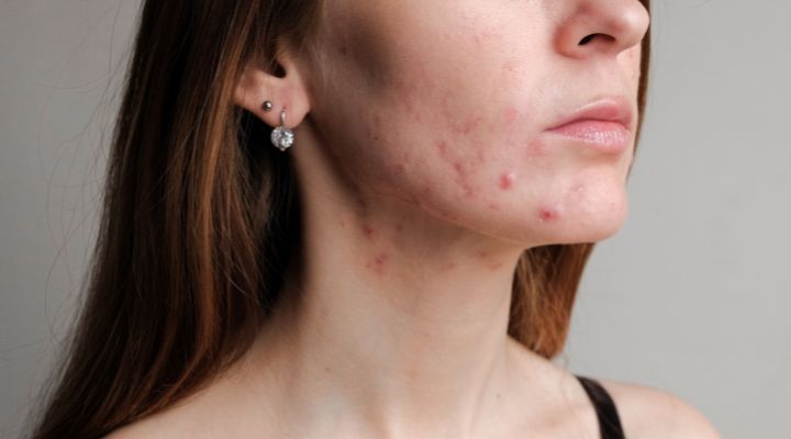 mulher com a pele cheia de manchas vermelhas marcada por acnes