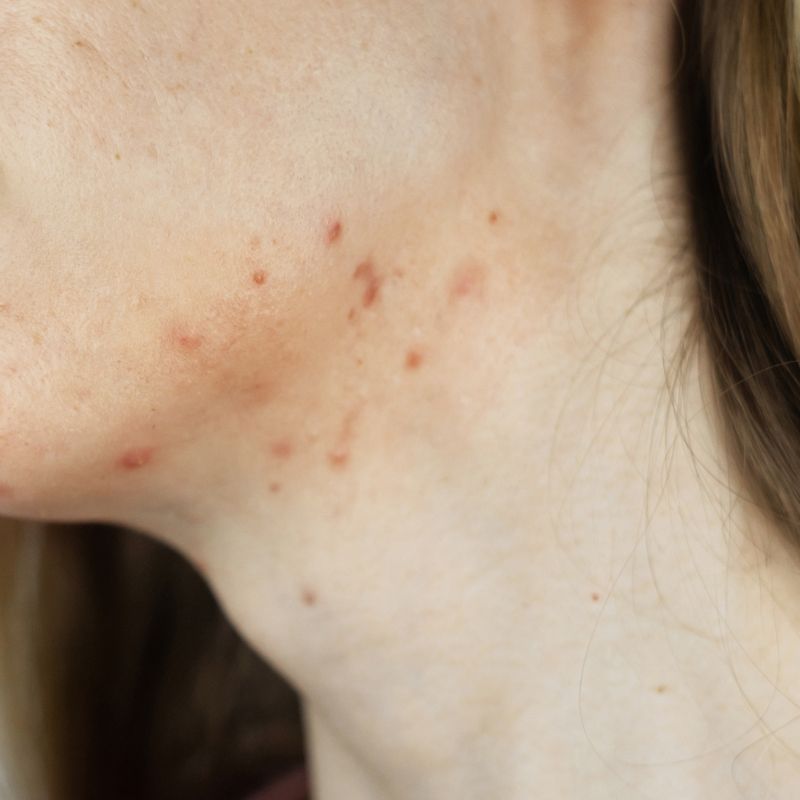 mulher com a pele marcada por acnes