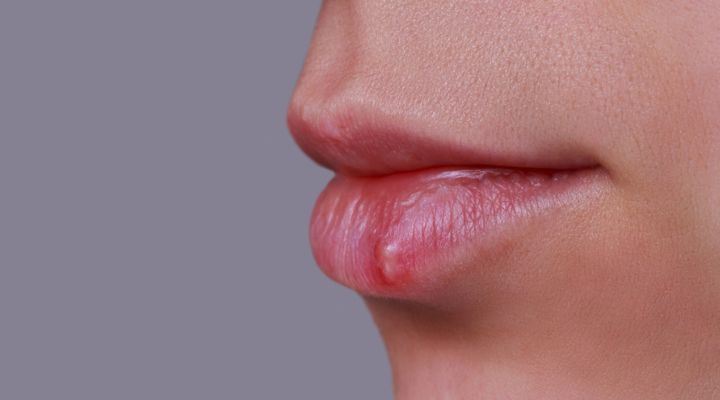 lábio com quelite labial