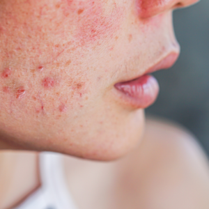 pessoa com acne grau 4