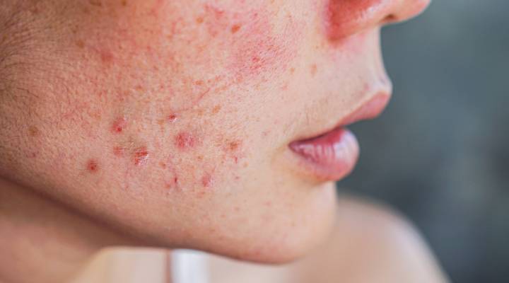 pessoa com acne no rosto