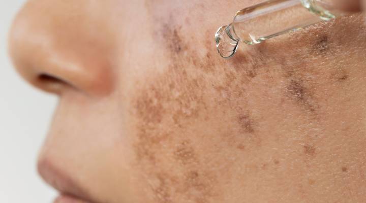 Produto para mancha escura