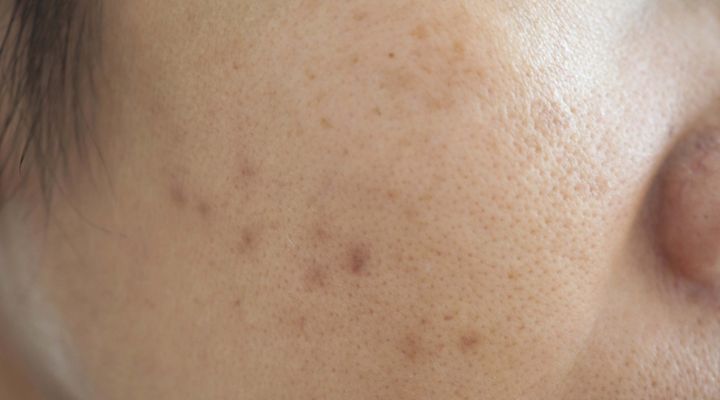 Rosto com pequenas cicatrizes de acne e poros visíveis.