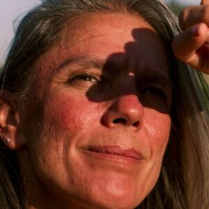 pessoa com queimadura de sol
