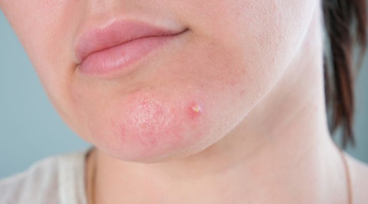 Pele com acne no queixo de uma mulher.