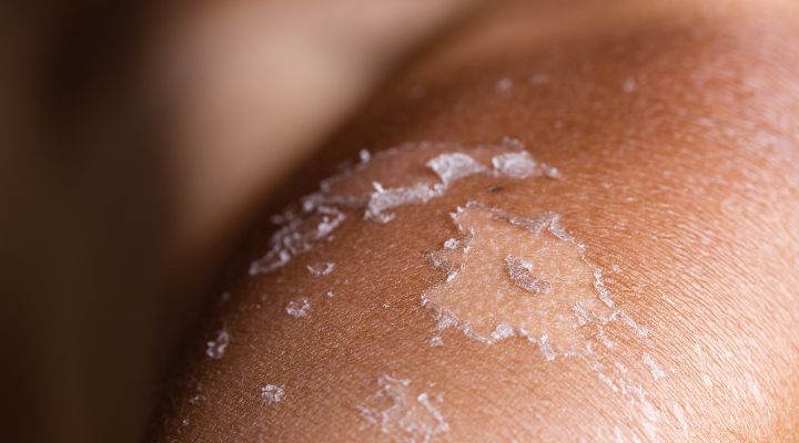 Pele com descamação e manchas secas visíveis