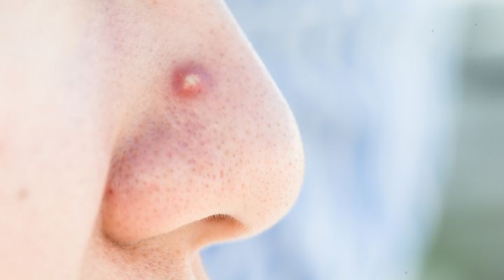 Pessoa com espinha no nariz em foco