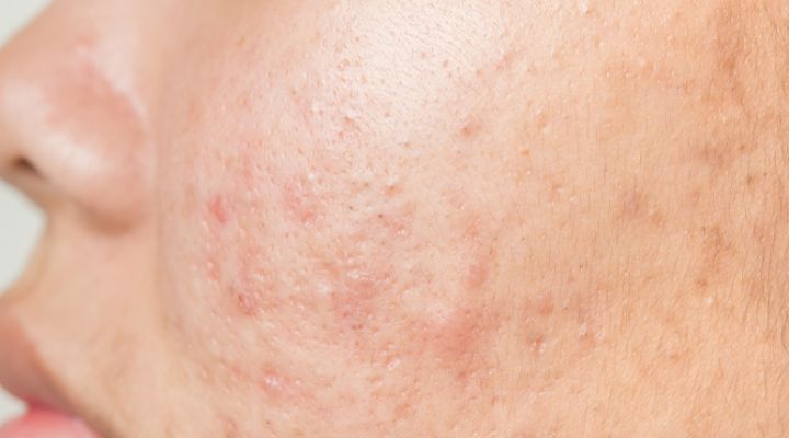 Pele com acne e cicatrizes visíveis ao lado.