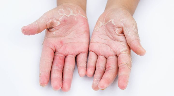 Mãos de criança com pele seca e rachaduras