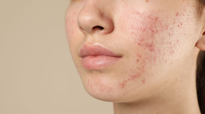 Pele com acne e marcas visíveis em close-up