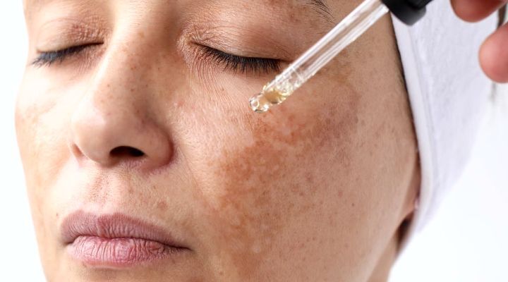 Aplicação de sérum facial em mulher com pele manchada