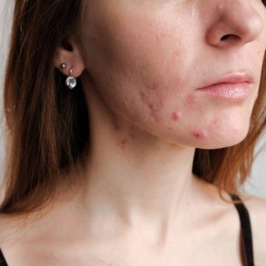 moça com as bochechas cheias de acnes