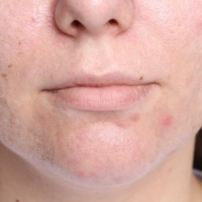 destaque acne interna