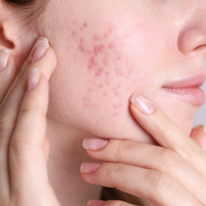 destaque acne na gravidez