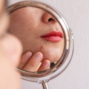 destaque tipos de acne