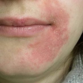 pessoa com dermatite no rosto