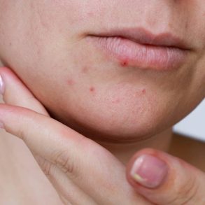 Close-up do queixo e boca com acne.