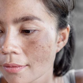 mulher com melasma no rosto