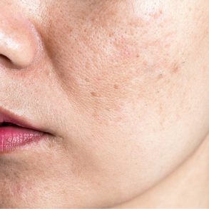 bochecha de pessoa com melasma