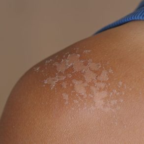 pele com mancha branca