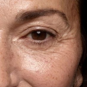 modelo com olhos afetados pela glicação