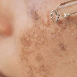 mancha-marrom-na-pele